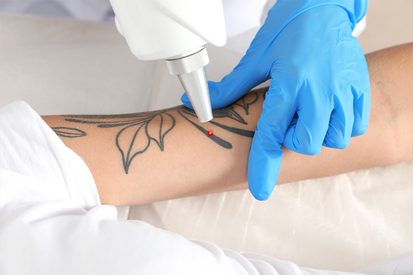 Laser Tattoo Removal Sydney  Best Tattoo Removal Treatment in Sydney