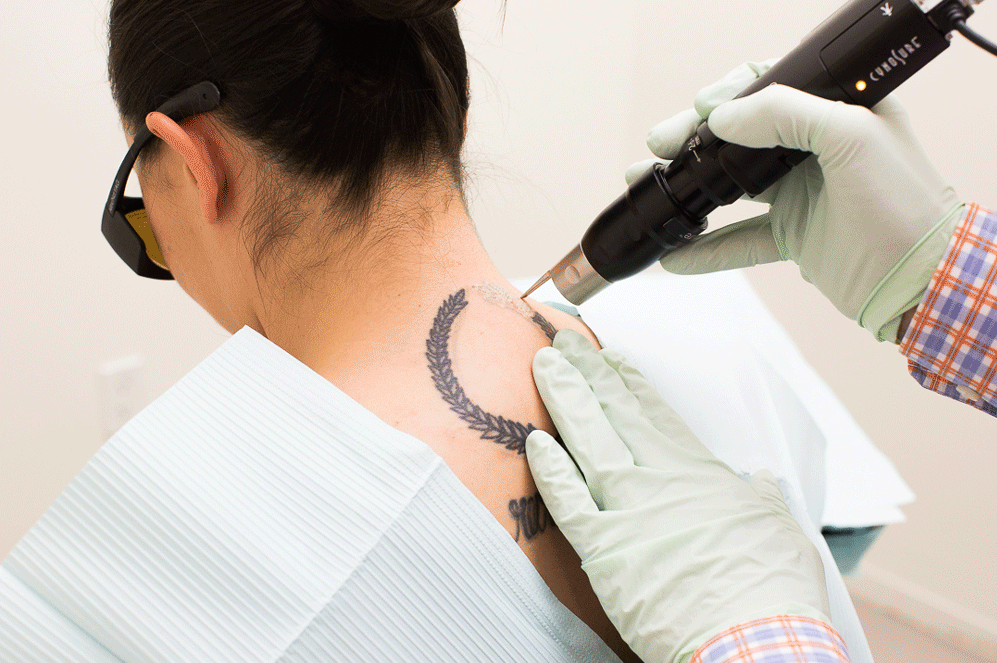 Best Tattoo Removal Treatments in Drummoyne Sydney  Fresha