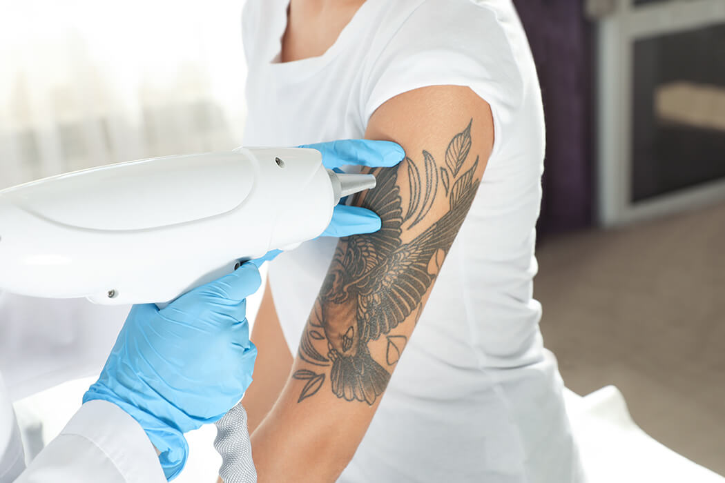 Tattoo Removal in Drummoyne Sydney by Qualified Professionals