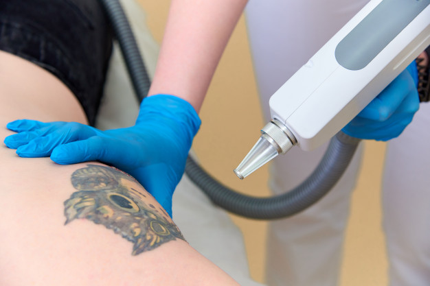 Tattoo Removal in Drummoyne Sydney by Qualified Professionals